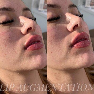 Lip Augmentation by Nurse Paty