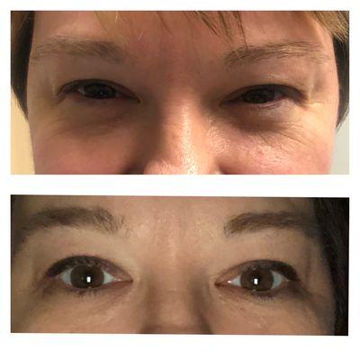 Plasma pen upper lid non surgical blepharoplasty!