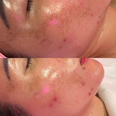 Chemical peel