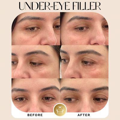 Under eye filler before and after