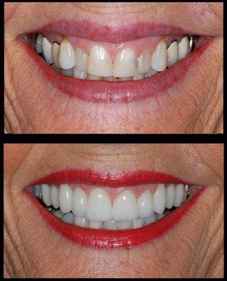 Our patient received veneers and crowns to restore her beautiful smile.