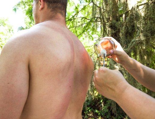 Traditional Cupping Therapy