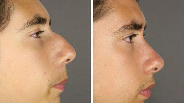 Rhinoplasty before and after.