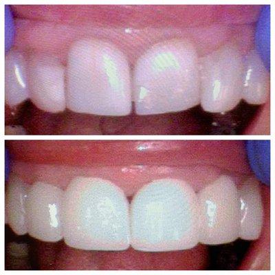 Porcelain veneers