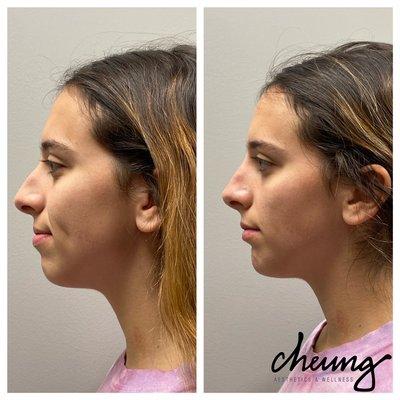 Immediately after filler injections to the nose and chin  for profile enhancement