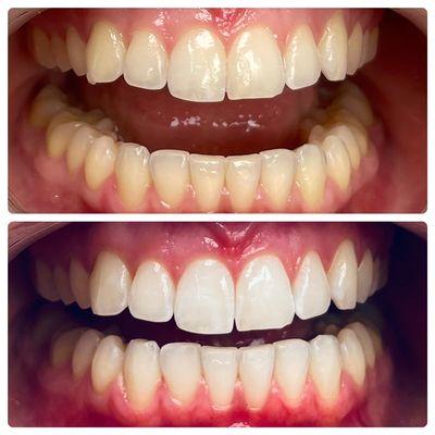 Teeth whitening