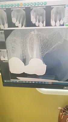 And after the root canal.