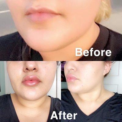 Lip Fillers