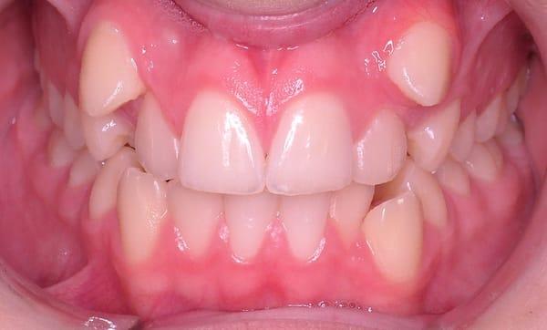 Wang Orthodontic Patient "A" Before