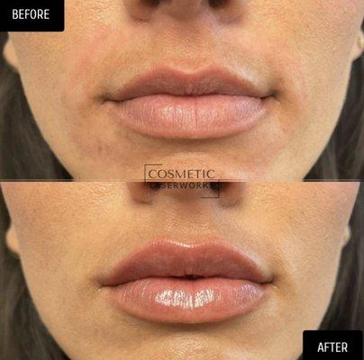 Lip Filler - Beverly Hills, CA Cosmetic Laser Works