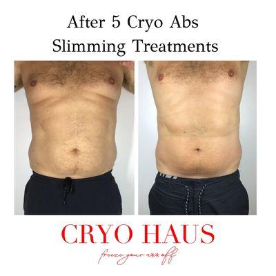 Check out before and after pics from 5 Cryo Ab treatments with our award winning Cryo T-Shock Machine!