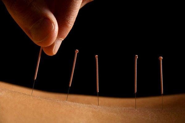 Dry needling can be beneficial for many issues including headaches and neck tension