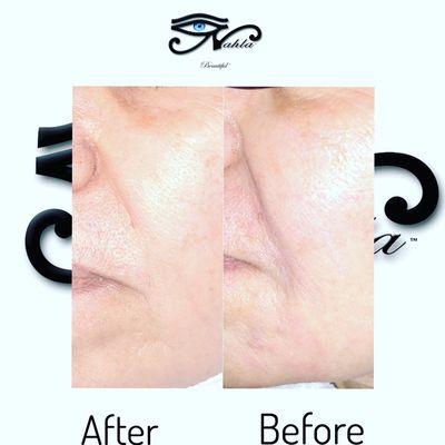 Dermal filler injections