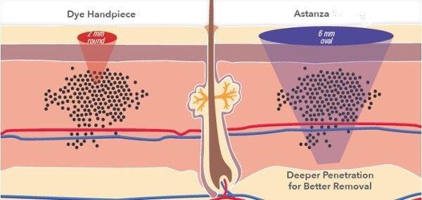 Astanza Laser for Tattoo Removal