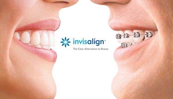 Invisalign or braces