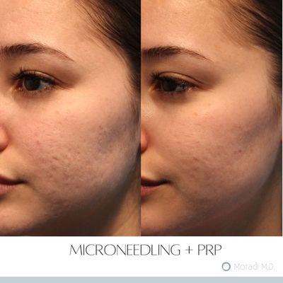 Microneedling + PRP