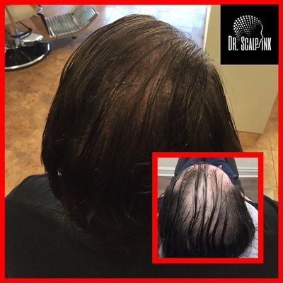 Density added to hair using scalp micro pigmentation