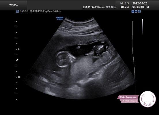 Baby ultrasound