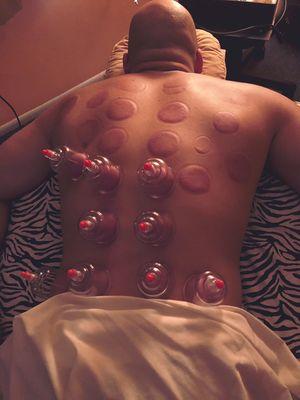 Cupping  massage