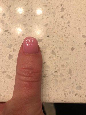 Thumb that looks like a toe