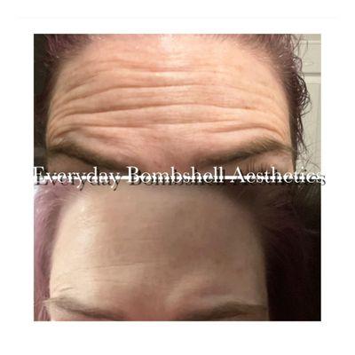 Forehead Botox 38 units