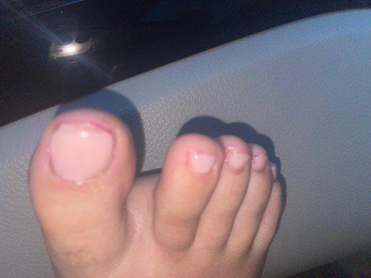 Bleeding toenails