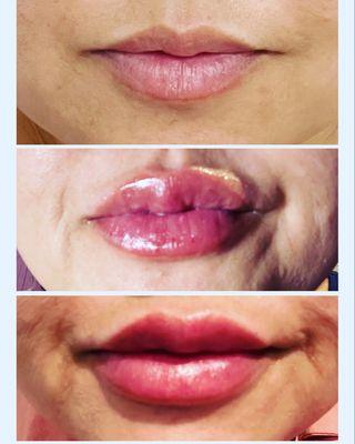 Hya Lip Infusion