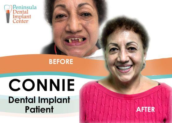 Full Mouth Top and Bottom Teeth Implant