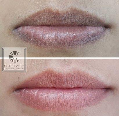 Before and after Lip Neutralization.