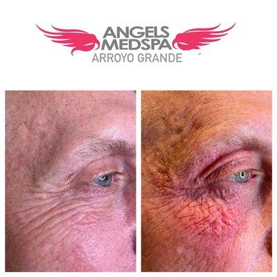 Fibroblast skin tightening for crows feet and upper lid, will heal within 7 days showing tighter firmer lifted skin.