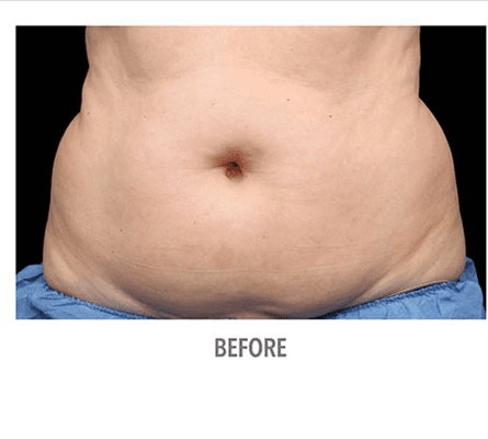 Before CoolSculpting