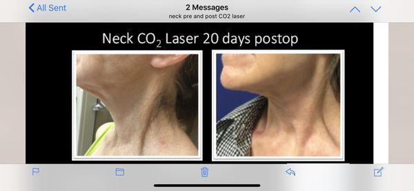 CO2 laser to help neck laxity