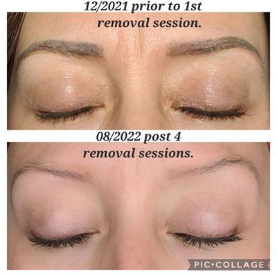 Before & after x4 brow laser removal sessions. I'm very happy with the results!