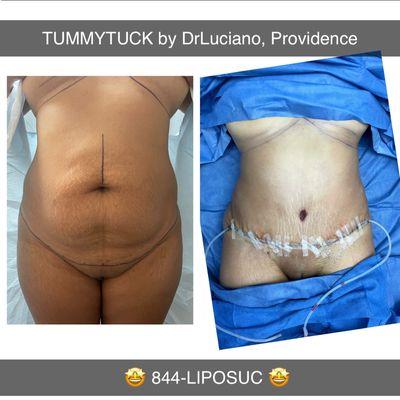 Tummytuck under local anesthesia.