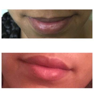 Before/after about half a syringe of juvaderm in top lip