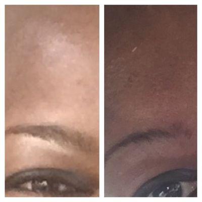 This is the left Brow   The Left side is before.  Right is after