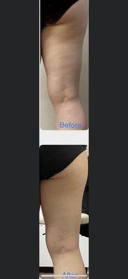 After treating the R Hip and Thigh muscles, it is accompanied by a slim effect.