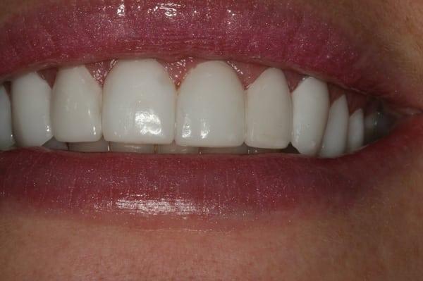 painless fast minimal preping of teeth