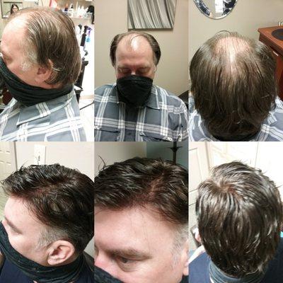 Men's non surgical hair replacement.