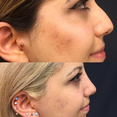 Rhinoplasty before and after