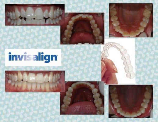 Actual Patient 12 months of invisalign