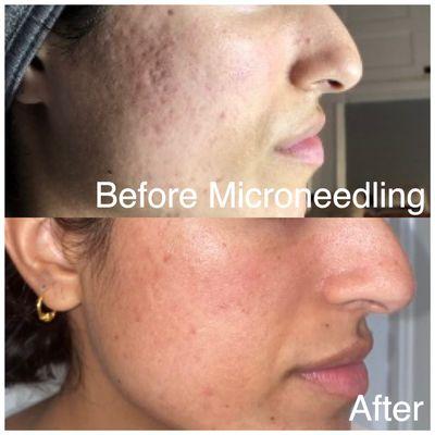 Medical Mechanical Microneedling by a Nurse Practitioner with 20+ years experience