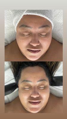 Hydrofacial before and after