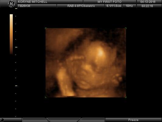 26 week 3D/4D Ultrasound