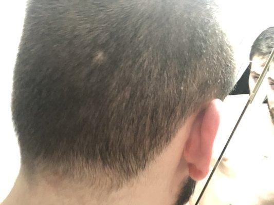 Bald spot and butchered hairline