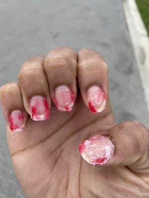 Nails after acetone was applied for 20 minutes