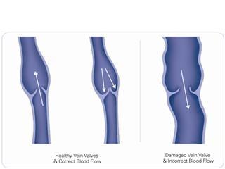 "Venous reflux occurs when blood flows the wrong direction in the leg veins, because of faulty valves."