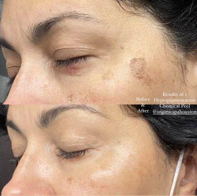 customized hyperpigmentation treatments