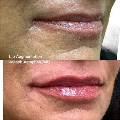 Lip Augmentation