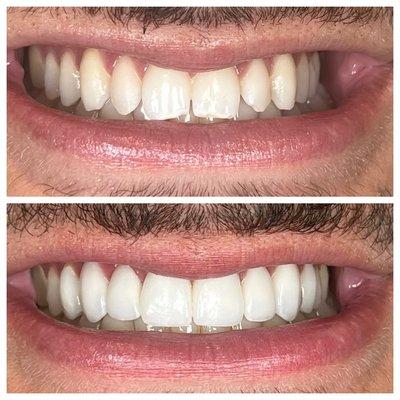 before and after- 12 hand crafted porcelain veneers,